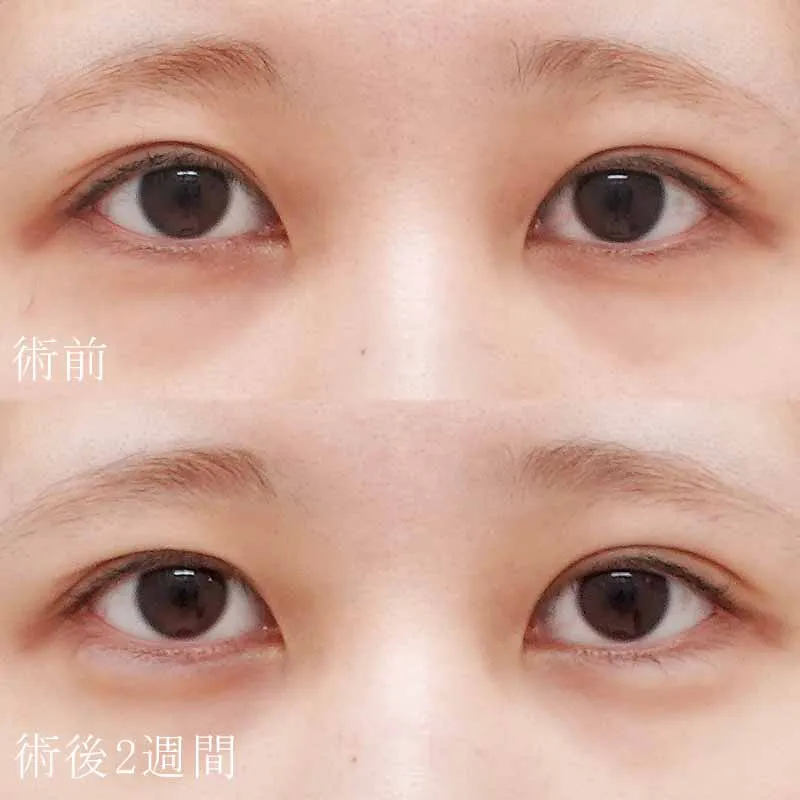 涙袋のヒアルロン酸注入の症例写真