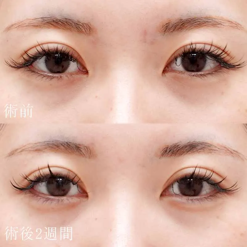 涙袋のヒアルロン酸注入の症例写真