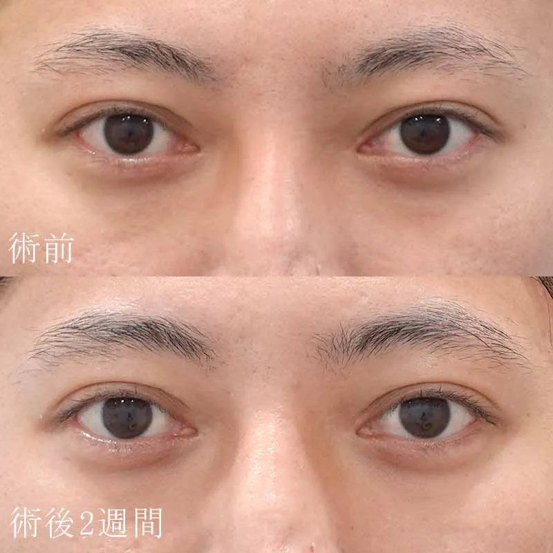 涙袋のヒアルロン酸注入の症例写真