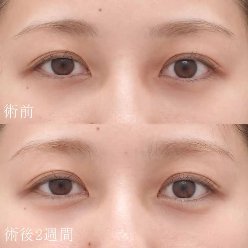 涙袋のヒアルロン酸注入の症例写真