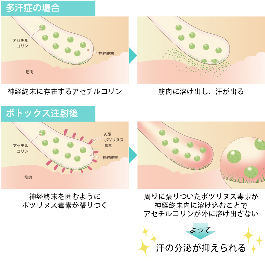 ボトックスによる汗止めの作用機序