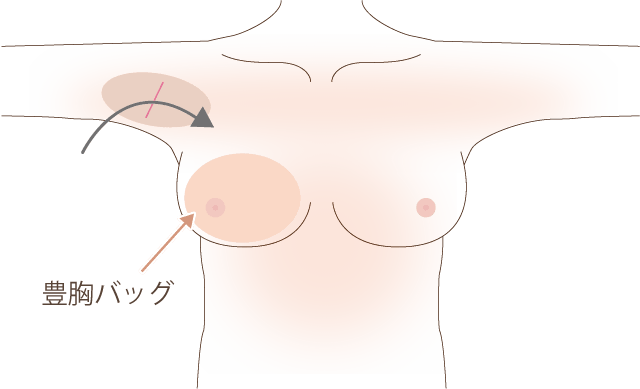 胸のシリコン挿入位置の図