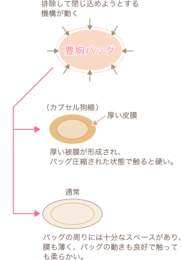 豊胸用シリコン拘縮の図