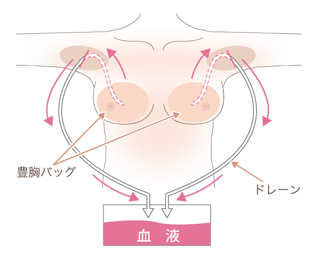 シリコンバック豊胸術後のドレーン装着図