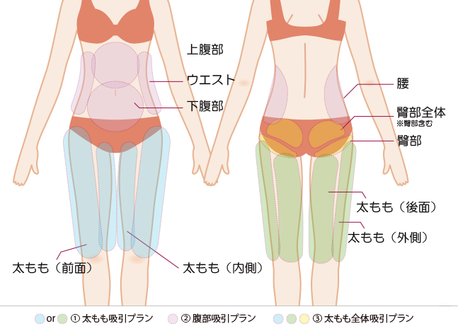 脂肪注入につかう脂肪の吸引箇所の図