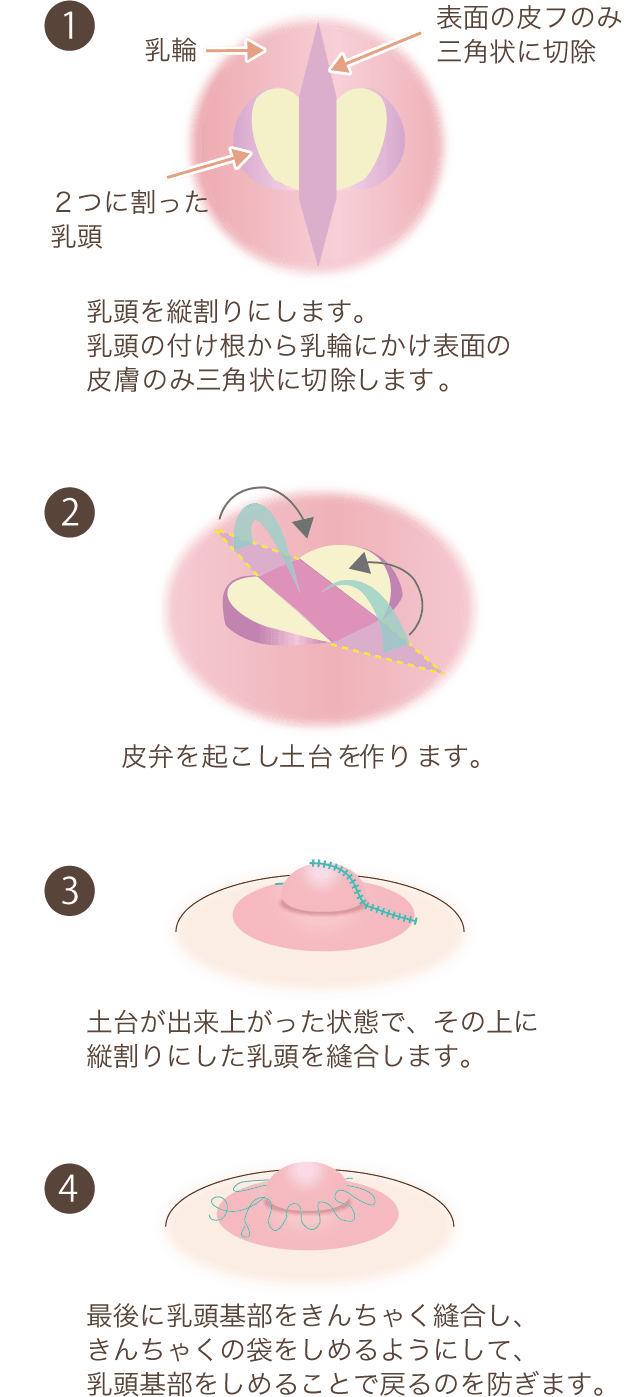 乳頭縮小の手術方法解説図