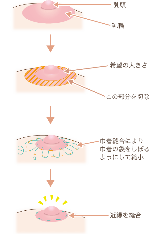 乳輪縮小の手術方法解説図