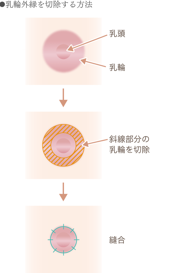 乳輪外縁の切除方法の図