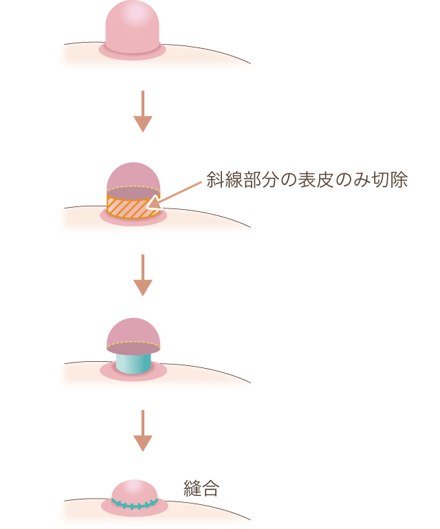 乳頭縮小（高さ）の仕組み図