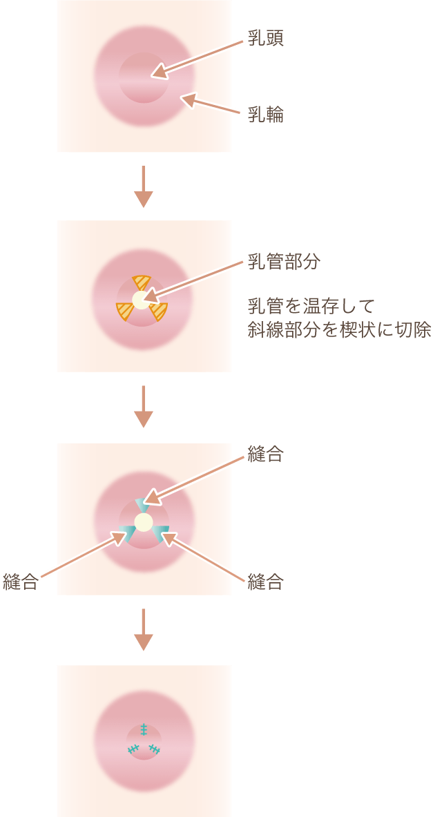 乳頭縮小（大きさ）の仕組み図