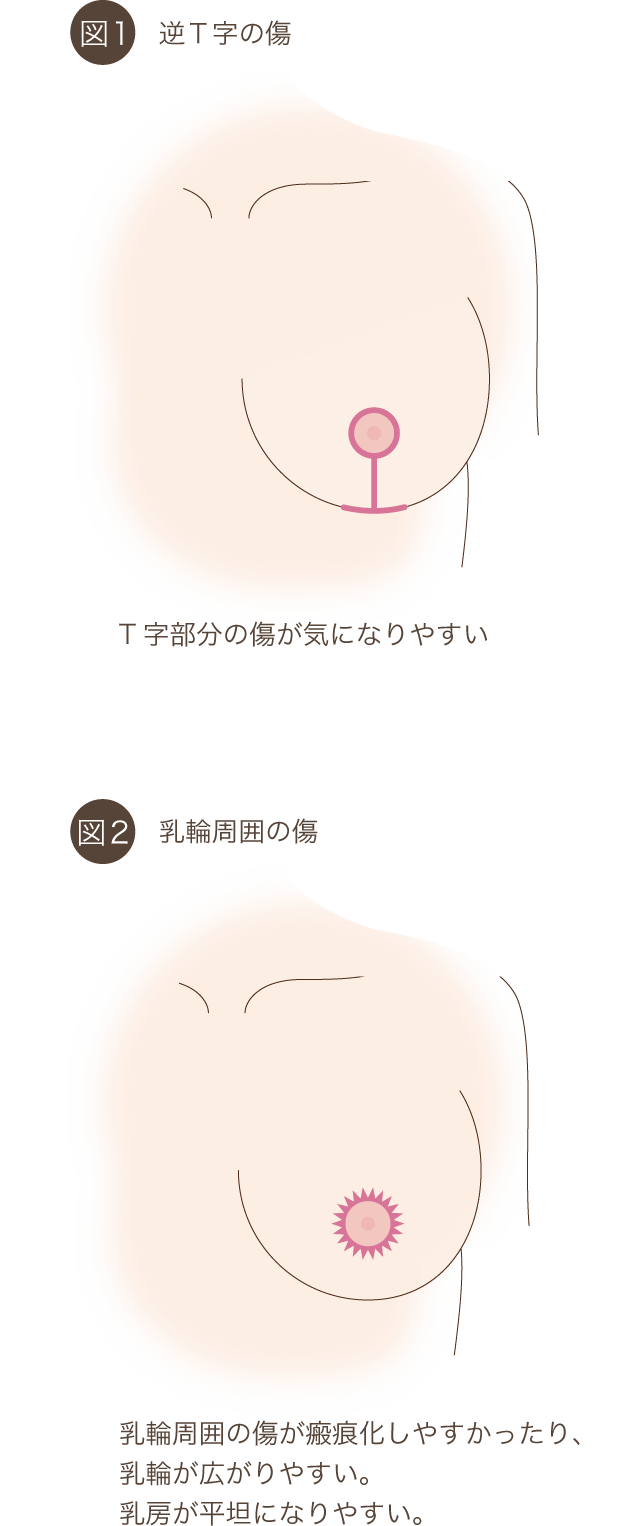 乳頭縮小・乳房吊り上げ術の施術の傷の図
