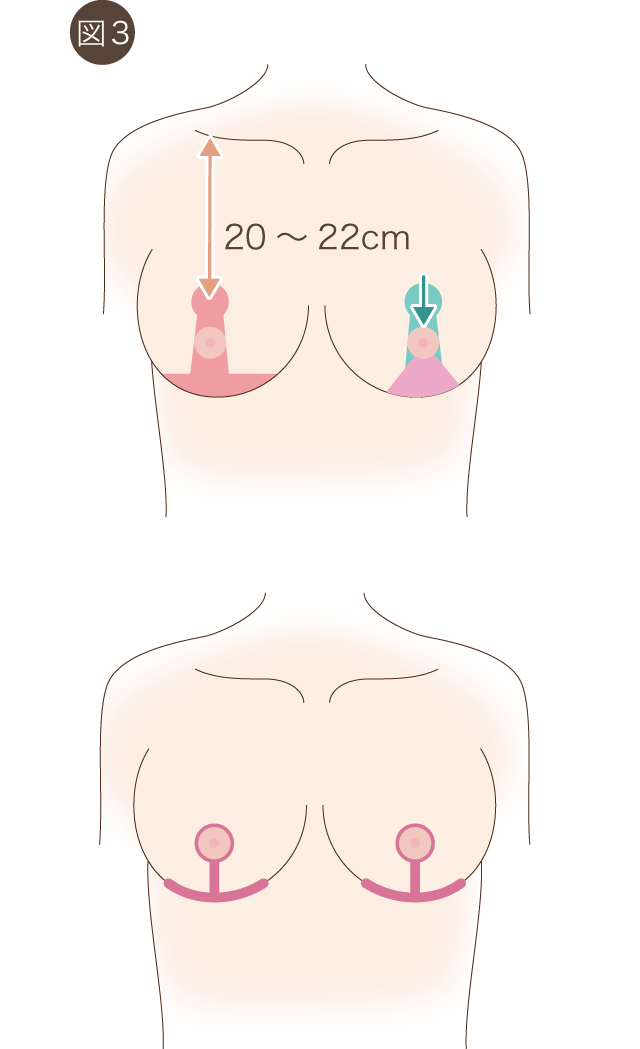 Pitanguy法での乳房吊り上げ術の図