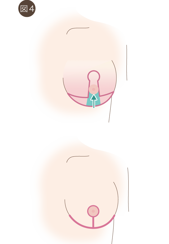 inferior pedicleでの乳房縮小の図