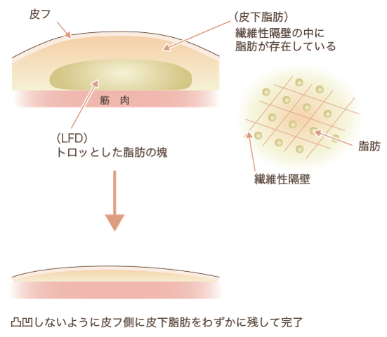 クリス・クロス法説明図