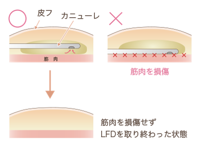 クリス・クロス法脂肪吸引説明図