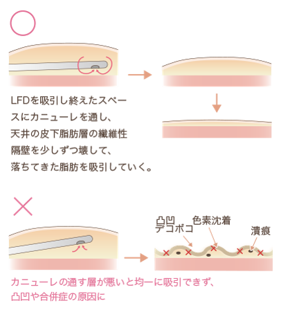 クリス・クロス法皮下脂肪層の吸引説明図