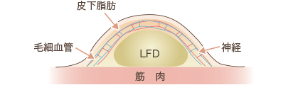 リサーフェイシング法説明図