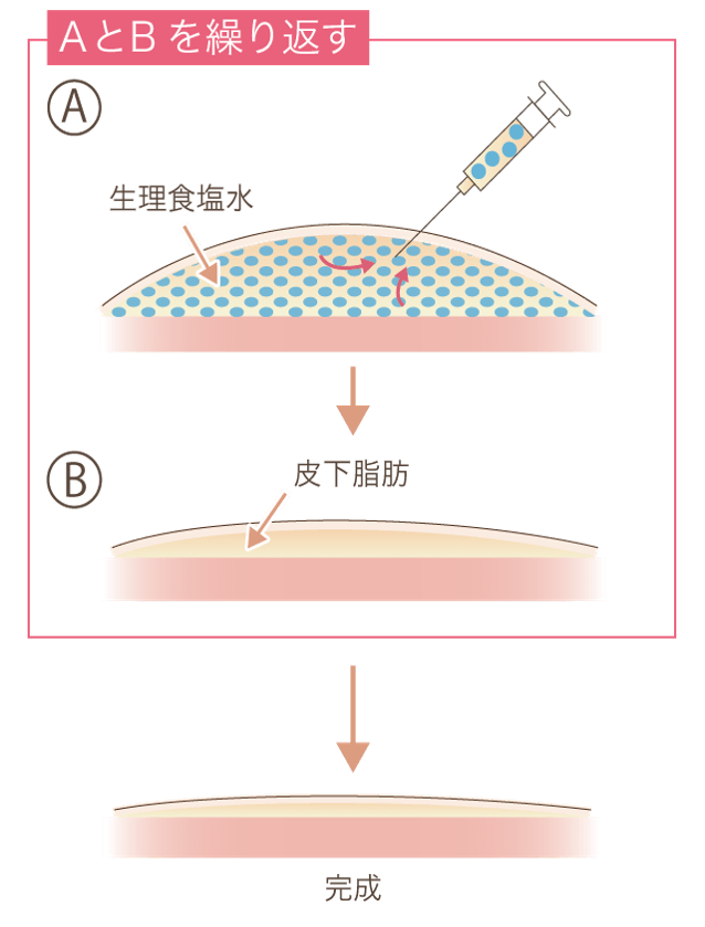 リサーフェイシング法説明図