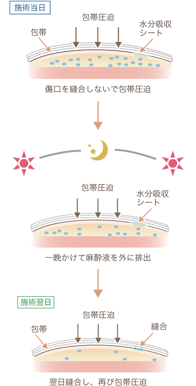 ドレナージ（翌日縫合）の場合説明図