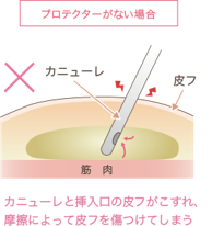 脂肪吸引 痩身の整形 施術内容一覧 美容整形 美容外科なら水の森美容外科 公式 総合サイト