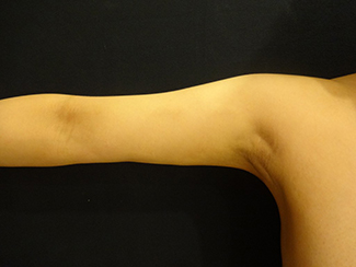 二の腕の脂肪吸引1（術後）振袖部分の変化