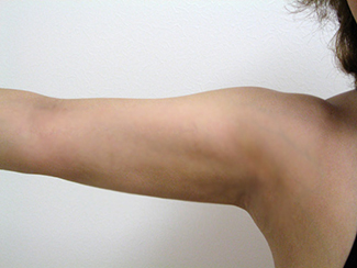 二の腕の脂肪吸引1（術後）元々太さがあるかたも細くなります