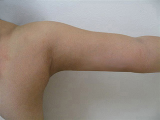 二の腕の脂肪吸引2（術後）元々太さがあるかたも細くなります