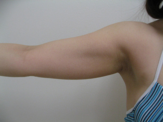 二の腕の脂肪吸引2（術前）振袖部分の変化