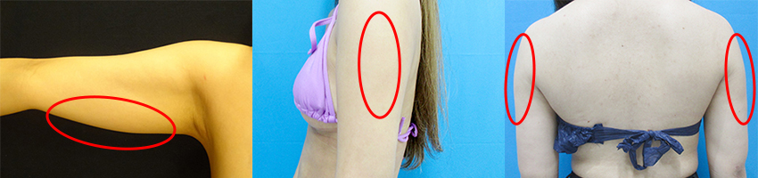当院の上腕の脂肪吸引の部位メニュー　二の腕（振袖+ 肩の張り出し）