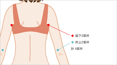 二の腕の脂肪吸引 美容整形なら水の森美容外科