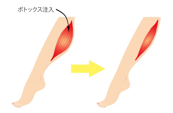 ふくらはぎのボトックス 注入認定医が在籍 美容整形 美容外科なら水の森美容外科 公式 総合サイト