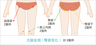 太ももの脂肪吸引の傷口　計8箇所