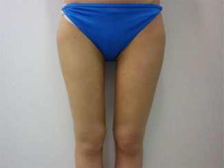 太ももの脂肪吸引の症例写真5（術後）太ももの内側にすき間