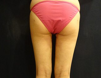 太ももの脂肪吸引の症例写真4（術後）太ももの内側にすき間