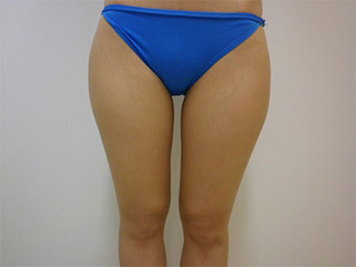 太ももの脂肪吸引の症例写真5（術前）太ももの内側にすき間