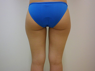 太ももの脂肪吸引の症例写真6（術前）太ももの内側にすき間