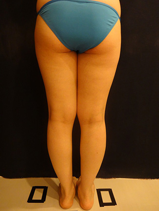 太もも・おしりの脂肪吸引の症例写真3（術前）後面