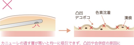 凸凹になってしまったの解説図