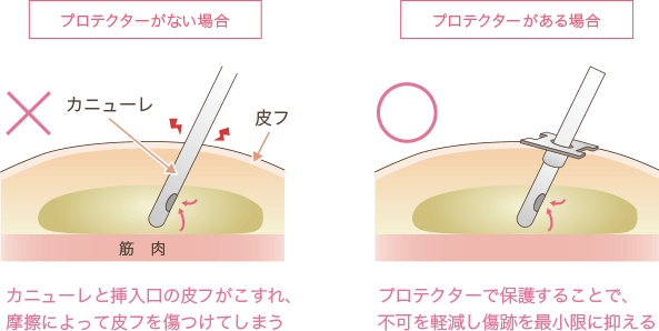 傷跡が目立たなくする工夫1