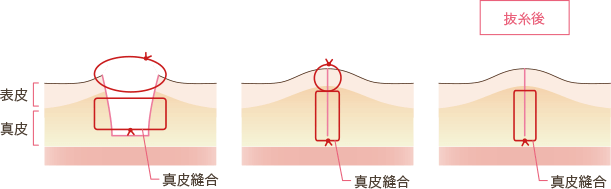 傷跡が目立たなくする工夫2