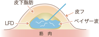 ベイザー脂肪吸引についての当院の見解