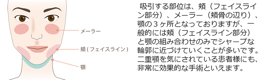 二重顎を機にされている患者様にも、非常に効果的な手術といえます。