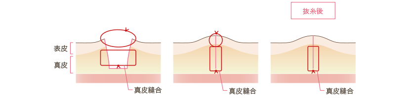 お腹の傷口の縫合の仕方
