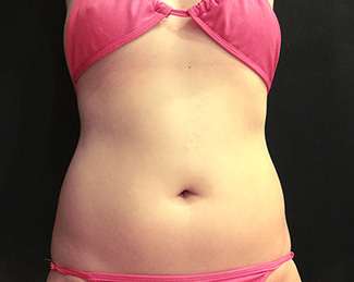 お腹の脂肪吸引1（術前）正面の症例写真