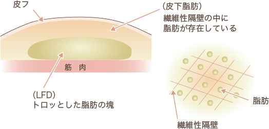 腰から吸引できる脂肪