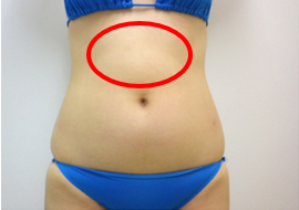上腹部の脂肪吸引　説明画像