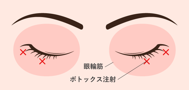 たれ目ボトックスの原理