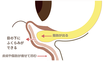 黒クマのある目元断面図