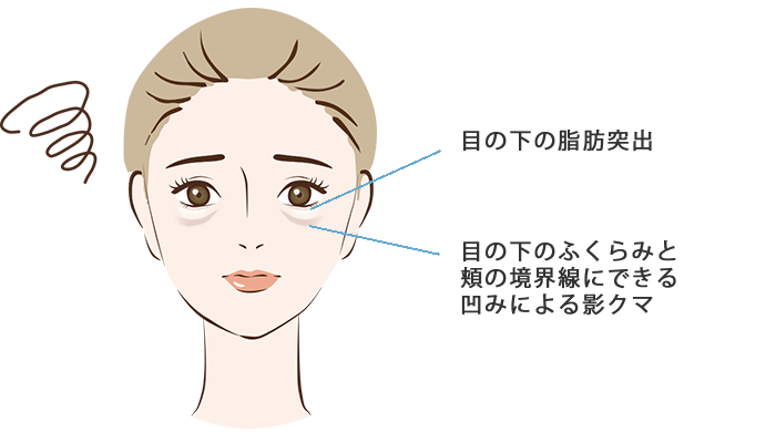 下眼瞼脱脂 目の下の脂肪取り の整形について 目 二重 整形 美容整形なら水の森美容外科 公式 総合サイト