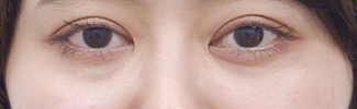 下眼瞼脱脂の症例写真（術前）
